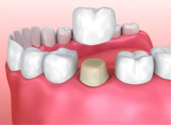 Dental Implant Restorations